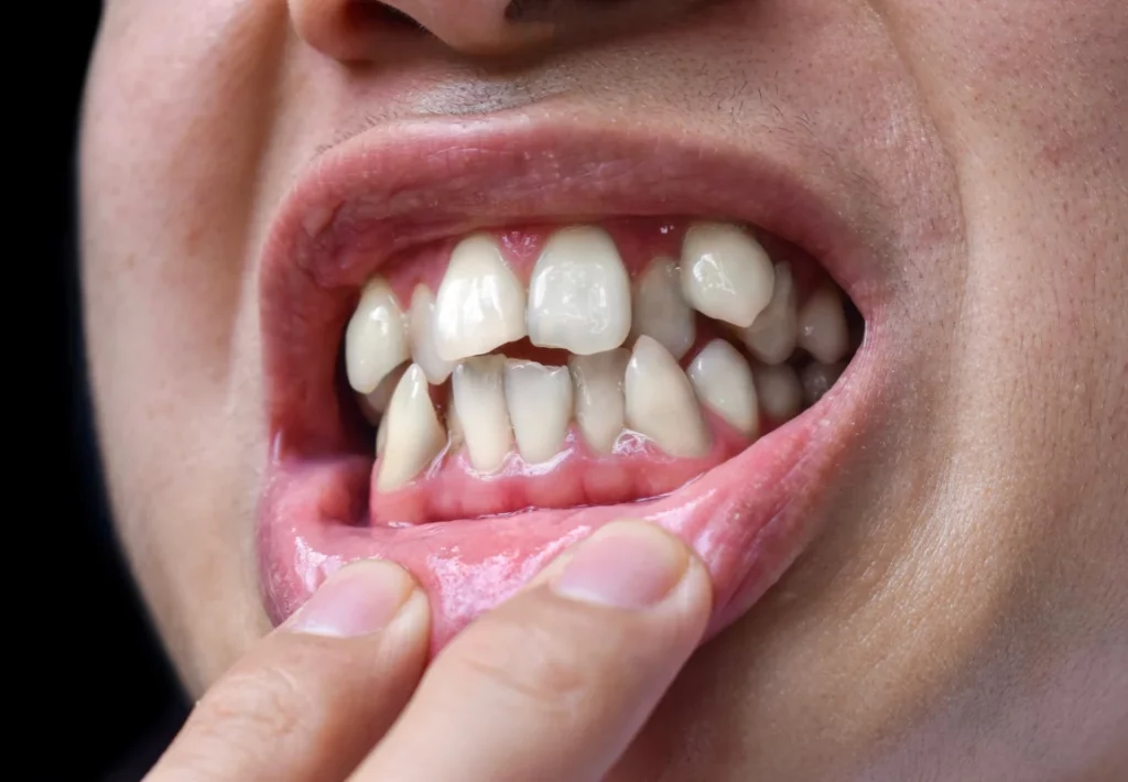 impacted canine teeth