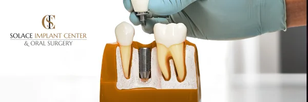 a cross section model of dental implants