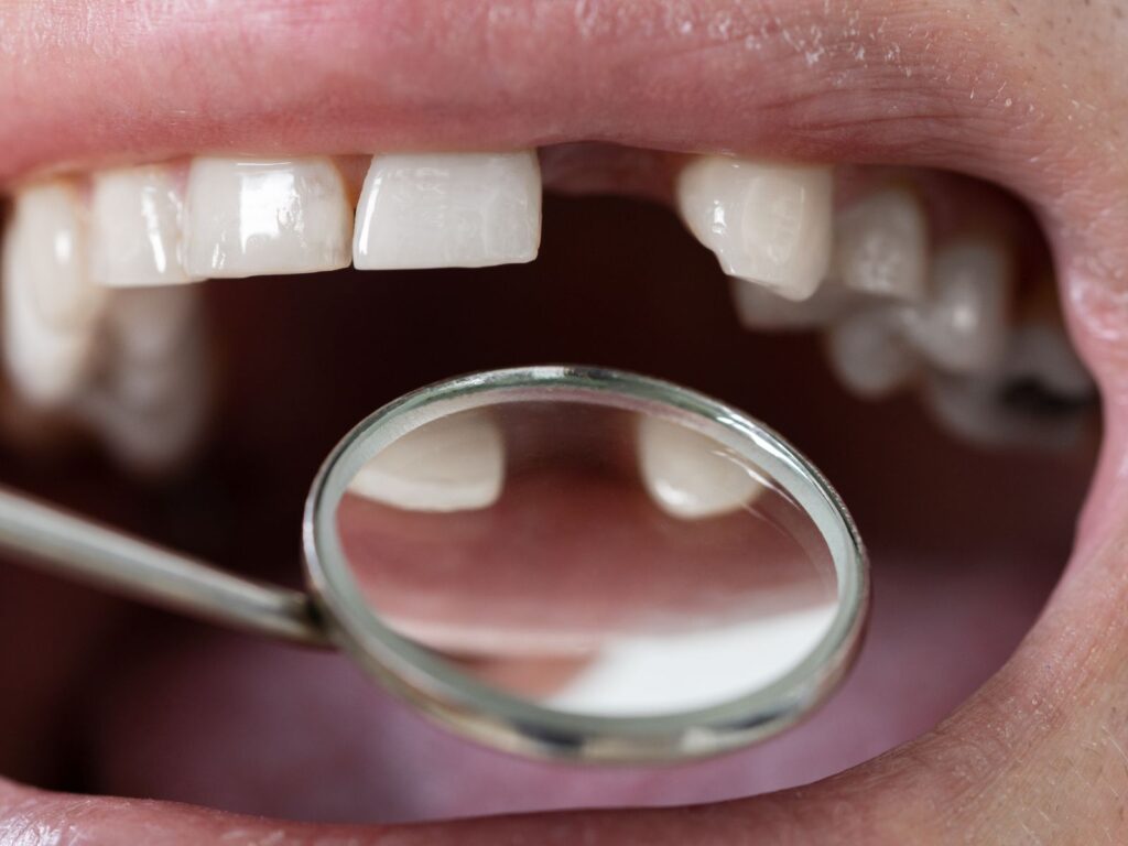 close up of a missing tooth