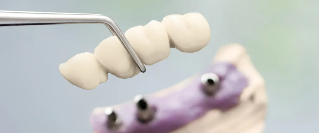 a model of a multiple teeth replacement dental implant