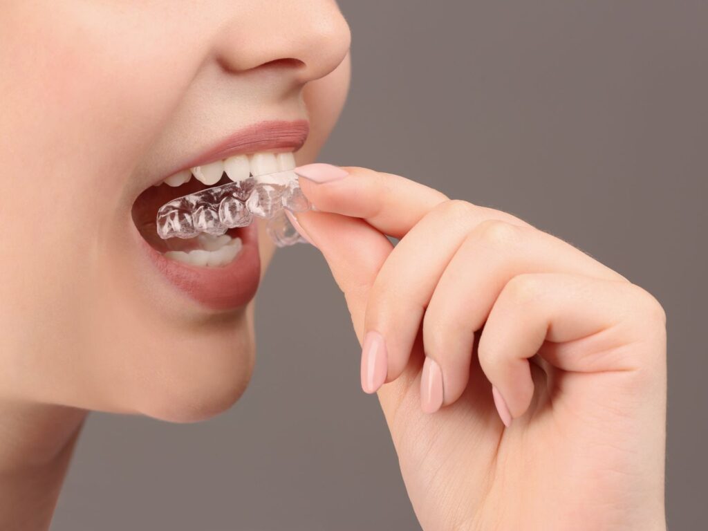 woman putting in a mouth guard / oral splints to protect against TMJ pain